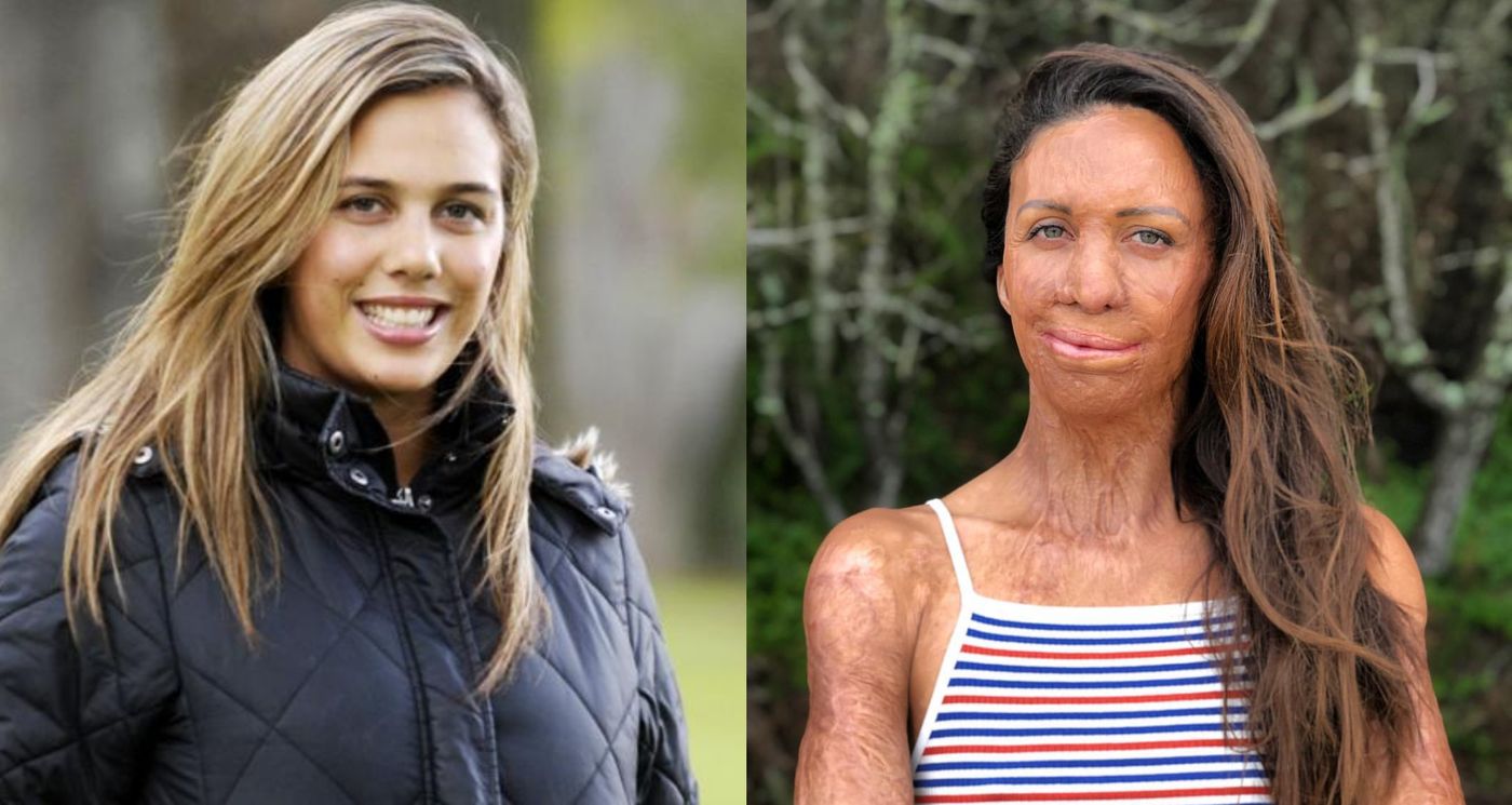 Turia Pitt